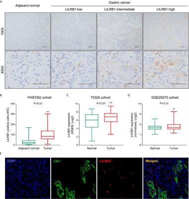 Poor Prognosis and Therapeutic Responses in LILRB1-Expressing M2 Macrophages-Enriched Gastric Cancer Patients